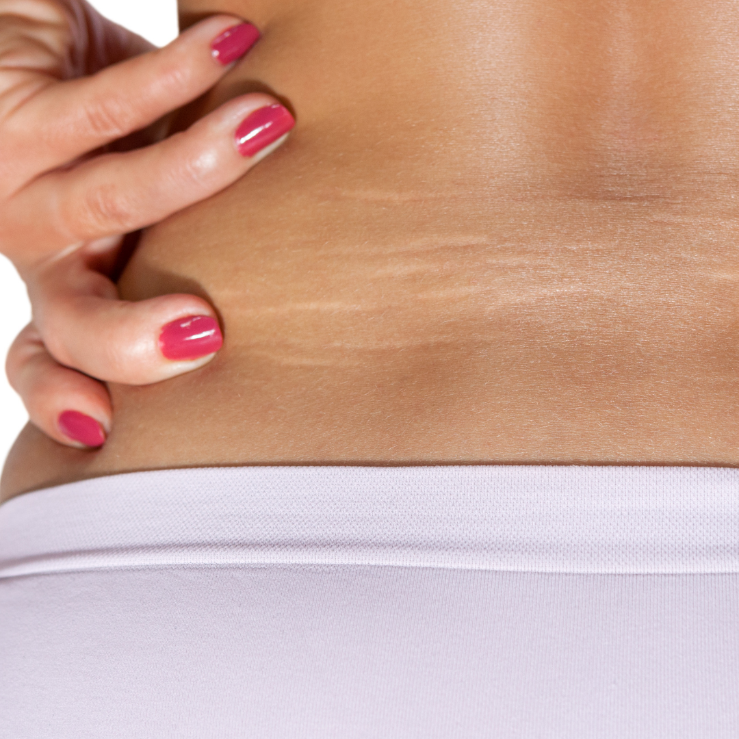 Stretch Mark Myths DEBUNKED